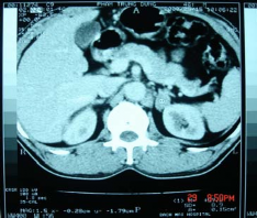 H ình 3 10 Pheochromocytome Bệnh nhân số 38 H ình 3 12 U không chế tiết có đè 1