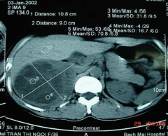 H ình 3 12 U không chế tiết có đè đẩy Bệnh nhân số 31 H ình 3 11 U vỏ có 2