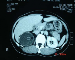 H ình 3 13 Nang tuyến thượng thận Bệnh nhân số 19 3 3 2 2 Một số đặc 3