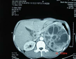 H ình 3 14 U vỏ không chế tiết có nang trong u Bệnh nhân số 46 H ình 3 15 4