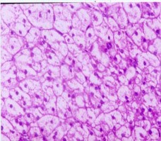 Hình 3 16 Đại thể u vỏ Hội chứng Conn Bệnh nhân số 85 Hình 3 17 Vi thể u 1