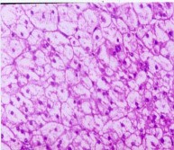 Hình 3 18 Đại thể u vỏ Hội chứng Cushing Bệnh nhân số 24 Hình 3 21 Vi thể u 2