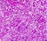 Hình 3 22 Vi thể pheochromocytome Bệnh nhân số33 Hình 3 20 Đại thể nang Bệnh 3