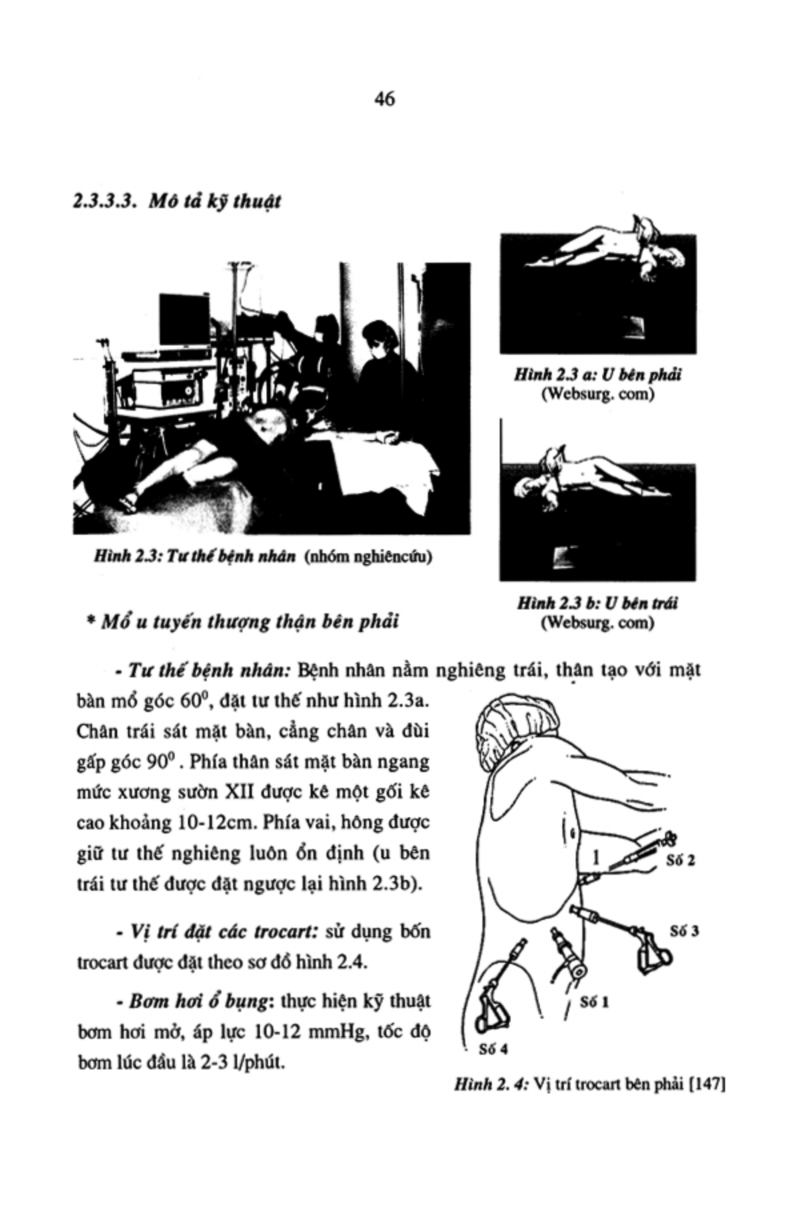 Nghiên cứu chẩn đoán và điều trị phẫu thuật nội soi các u tuyến thượng thận lành tính tại bệnh viện Việt Đức giai đoạn 1998 2005 8 1