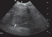 Hình 4 14 Hình ảnh u gan ở thùy đuôi gan mũi tên Hình 4 15 Hình ảnh xơ gan 2
