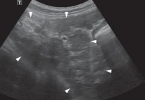 Hình 4 14 Hình ảnh u gan ở thùy đuôi gan mũi tên Hình 4 15 Hình ảnh xơ gan 3