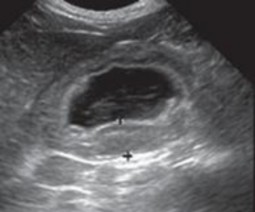 Hình 4 18 Hình ảnh viêm dạ dày mũi tên Nếu tắc ruột cơ học do các dị 4