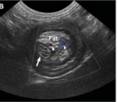 Hình 4 19 Hình ảnh lồng ruột mũi tên Hình 4 20 Hình ảnh dị vật trong ruột 5