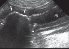 Hình 4 19 Hình ảnh lồng ruột mũi tên Hình 4 20 Hình ảnh dị vật trong ruột 6