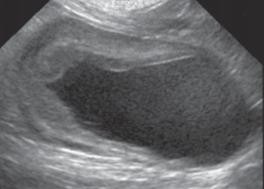 Hình 4 23 Hình ảnh sỏi bàng quang mũi tên Trong tất cả các trường hợp kiểm 7