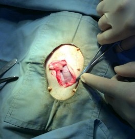 Phương pháp phẫu thuật ngoại khoa Hình ảnh bộc lộ tử cung bị viêm Tử cung 11