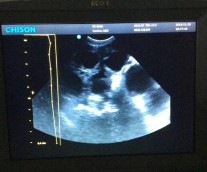 MỘT SỐ HÌNH ẢNH TRONG QUÁ TRÌNH TRIỂN KHAI ĐỀ TÀI Triệu chứng viêm tử cung 3