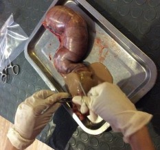 Phương pháp phẫu thuật ngoại khoa Hình ảnh bộc lộ tử cung bị viêm Tử cung 9