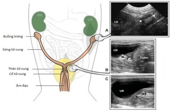 Hình 2 4 Đường sinh dục con cái bình thường bên trái là một sơ đồ biểu 1
