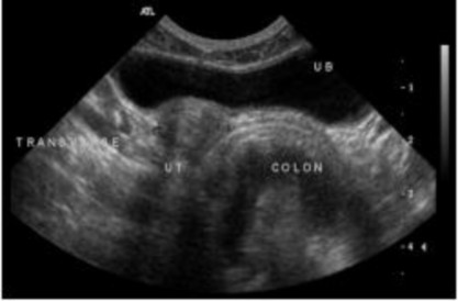 Hình 2 8 Hình ảnh cắt ngang của thân tử cung vị trí nhìn thấy ở giữa bàng 5