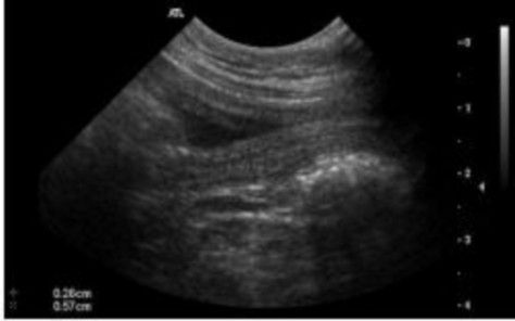 Hình 2 9 Hình ảnh mặt cắt thẳng đứng dọc ở chính giữa của thân tử cung 6