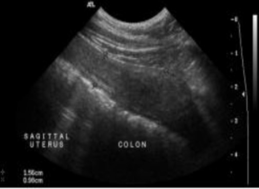 Hình 2 10 Hình ảnh mặt cắt thẳng đứng ở chính giữa của cổ tử cung được 7