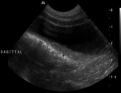 Hình 2 11 Hình ảnh mặt cắt thẳng đứng ở chính giữa của thân tử cung trong 8