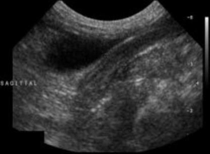 Hình 2 12 Hình ảnh mặt cắt thẳng đứng ở chính giữa của thân tử cung trong 9