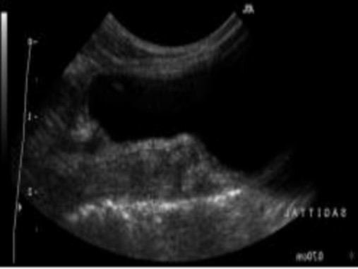 Hình 2 13 Ảnh mặt cắt thẳng đứng ở chính giữa của thân tử cung trong giai 1