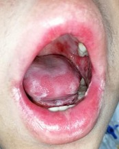 B Hình 1 Hình ảnh tổn thương niêm mạc do phác đồ điều kiện hóa A B Hình 2 1