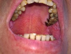 Hình 1 Hình ảnh tổn thương niêm mạc do phác đồ điều kiện hóa A B Hình 2 2