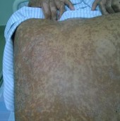 A B Hình 2 Hình ảnh bệnh ghép chống chủ cấp ở da A và niêm mạc B Hình 10 3