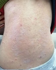 Hình 10 Hình ảnh tổn thương da do bệnh ghép chống chủ mạn 4