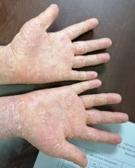 Hình 10 Hình ảnh tổn thương da do bệnh ghép chống chủ mạn 5