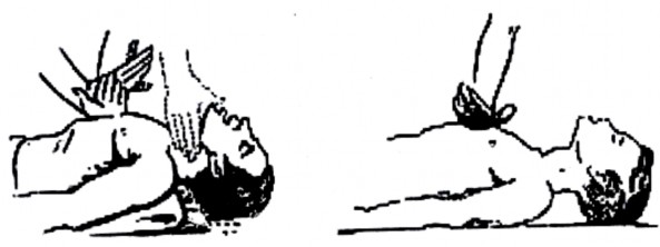 Hình 2 7 Phương pháp hà hơi thổi ngạt miệng – mũi Thổi ngạt kết hợp với 3