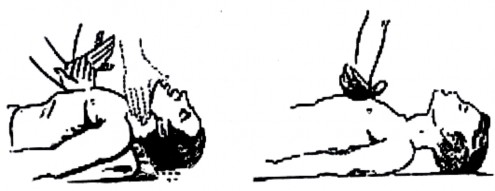 Nếu có một người cấp cứu thì cứ sau hai ba lần thổi ngạt ấn vào lồng 5