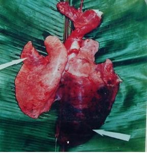 Hình 3 2 Phổi bị gan hóa 2 5 3 Triệu chứng Sốt đột ngột 41 42 0 C trong 6 9 ngày 1