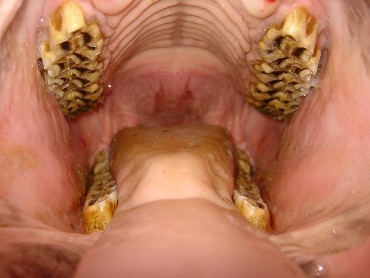 2 1 2 Yết hầu Hình 10 Răng ngựa Là 1 xương ngắn hẹp nằm sau xương miệng và 2