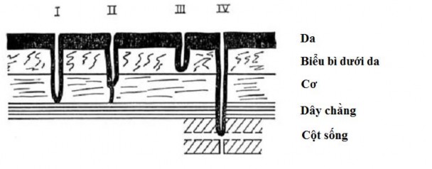 Hình 1 14 Các loại triệu chứng demoid sinus DS trên chó lưng xoáy 94 Dị tật xoang 4