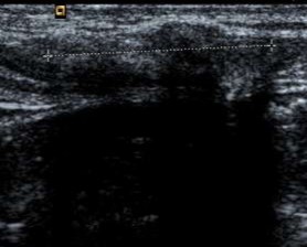 Hình 3 1 Hình ảnh siêu âm mô xơ ở vùng bẹn phải xuất hiện đường tăng âm 1