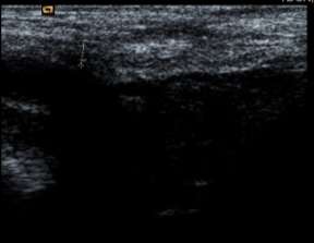 Hình 3 1 Hình ảnh siêu âm mô xơ ở vùng bẹn phải xuất hiện đường tăng âm 2