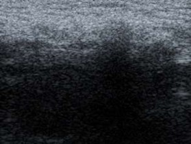 Hình 3 2 Hình ảnh siêu âm mô xơ ở vùng bẹn trái xuất hiện đường tăng âm 3