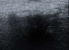 Hình 3 2 Hình ảnh siêu âm mô xơ ở vùng bẹn trái xuất hiện đường tăng âm 4