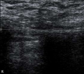 Hình 3 3 Hình ảnh siêu âm mô xơ ở vùng bẹn phải xuất hiện đường tăng âm 5