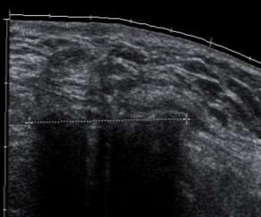 Hình 3 3 Hình ảnh siêu âm mô xơ ở vùng bẹn phải xuất hiện đường tăng âm 6
