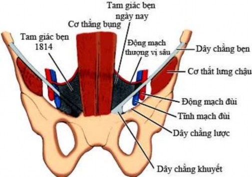 Hình 1 4 Tam giác bẹn Nguồn Skandalakis 2004 110 Phúc mạc khi phủ lên các thừng 6