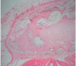 a×40 b×100 Hình 1 15 Phản ứng tế bào dị vật khổng lồ và tế bào sợi xơ tìm 4