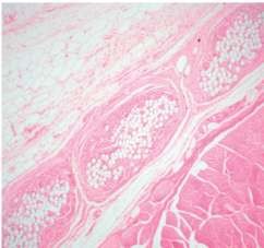 b×100 Hình 1 15 Phản ứng tế bào dị vật khổng lồ và tế bào sợi xơ tìm 5