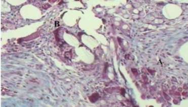 Hình 1 16 Phản ứng viêm tế bào hạt dị vật A tế bào sợi xơ B độ phóng 1