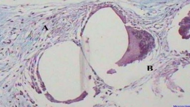 Hình 1 17 A Phản ứng tế bào hạt dị vật tìm thấy kín đáo khi đặt lưới 2