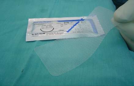 Hình 2 1 Tấm lưới nhân tạo Premilene Chỉ phẫu thuật Khâu cố định tấm lưới 1