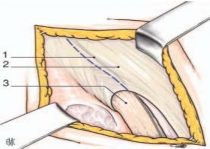 Hình 2 2 1 Thần kinh chậu bẹn 2 Cân cơ chéo lớn 3 Thừng tinh Mở cân cơ chéo 2