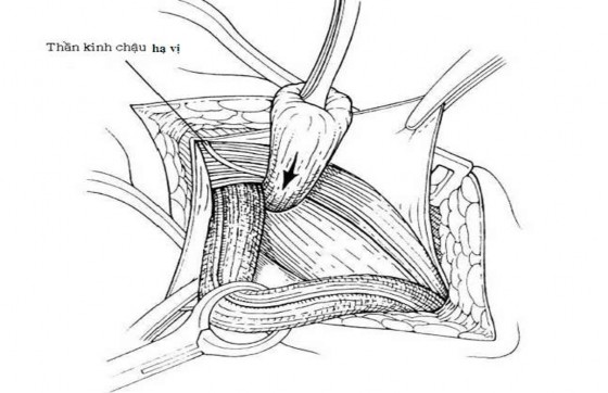Hình 2 3 Bóc tách cao khâu buộc túi thoát vị gián tiếp ngay lỗ bẹn sâu Nguồn 3