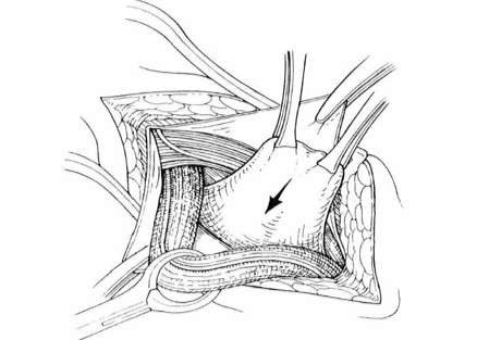 Hình 2 4 Xác định giới hạn của cổ túi thoát vị trực tiếp và lộn vào phía 4