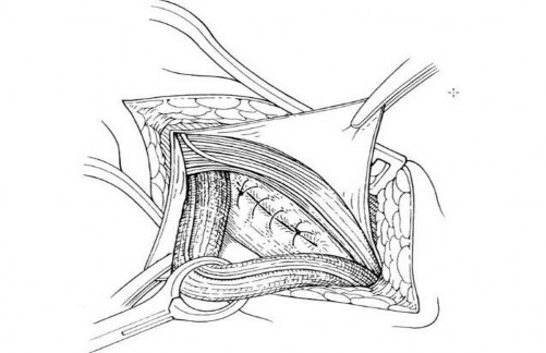 Hình 2 5 Khâu vùi sau khi lộn túi thoát vị trực tiếp Nguồn Kurzer M Belsham P A Kark 5